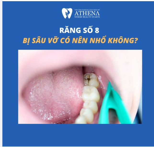 Răng Số 8 Bị Sâu Vỡ: Nguyên Nhân và Hậu Quả