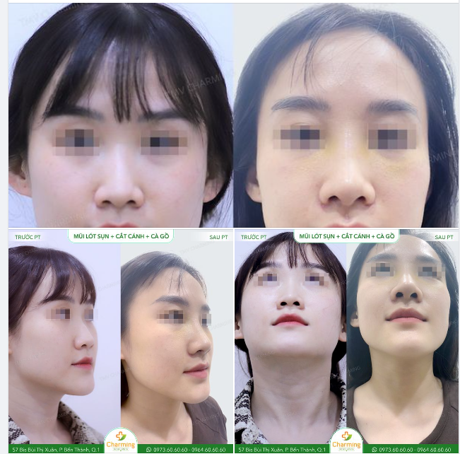 Chiếc mũi gồ, dáng thấp, nhỏ của nàng khách khiến cả gương mặt nàng trông rất mất cân đối.