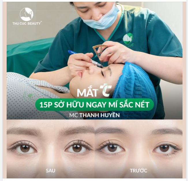 Chiêm ngưỡng nếp mí nét căng chỉ sau 15P thực hiện