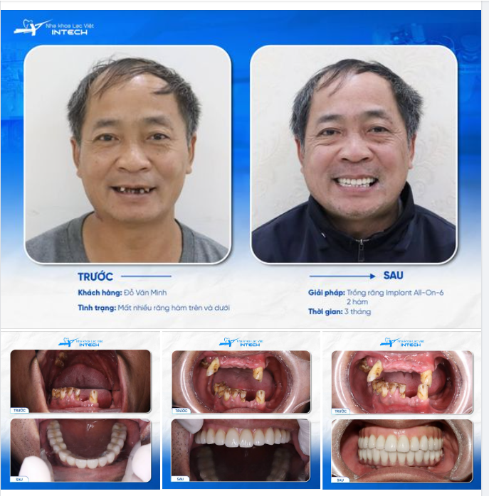TỪNG NHỊN ĂN VÌ KHÔNG NHAI ĐƯỢC CƠM, KHÁCH HÀNG HẠNH PHÚC ĂN NHAI THOẢI MÁI SAU KHI TRỒNG IMPLANT