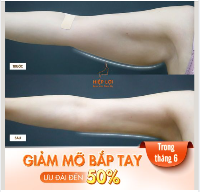 GIẢM MỠ BẮP TAY- Ưu đãi giảm đến 50%, được trực tiếp Bác Sĩ Phan Hiệp Lợi tư vấn thăm khám  thực hiện tại bệnh viện