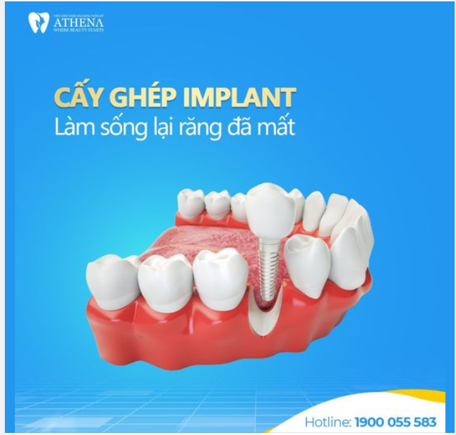 CẤY GHÉP IMPLANT - ĐEM "THANH XUÂN" LẠI VỀ BÊN BẠN!