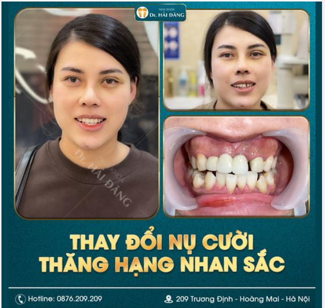 RỦI RO KHI BỌC RĂNG SỨ GIÁ RẺ
