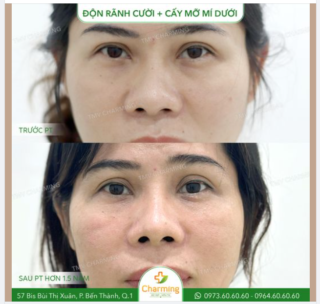 Phần rãnh cười nếu quá sâu sẽ làm gương mặt của mọi người trông già dặn hơn, và nụ cười cũng trở nên kém duyên hơn.