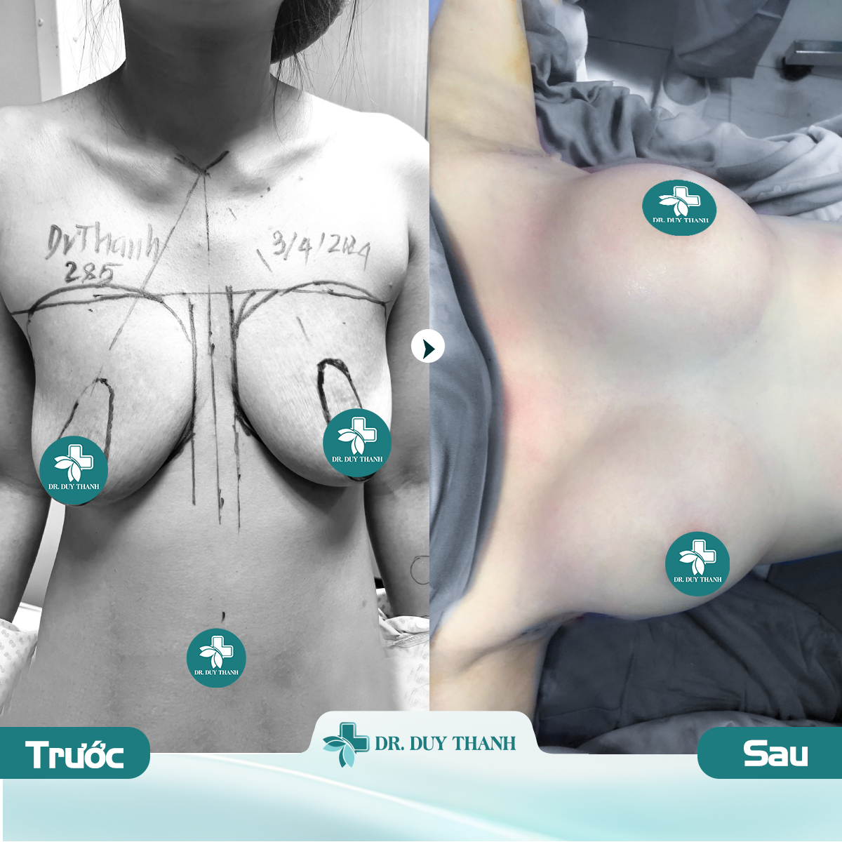 Dr Duy Thanh nâng ngực, treo sa trễ không đau không sẹo