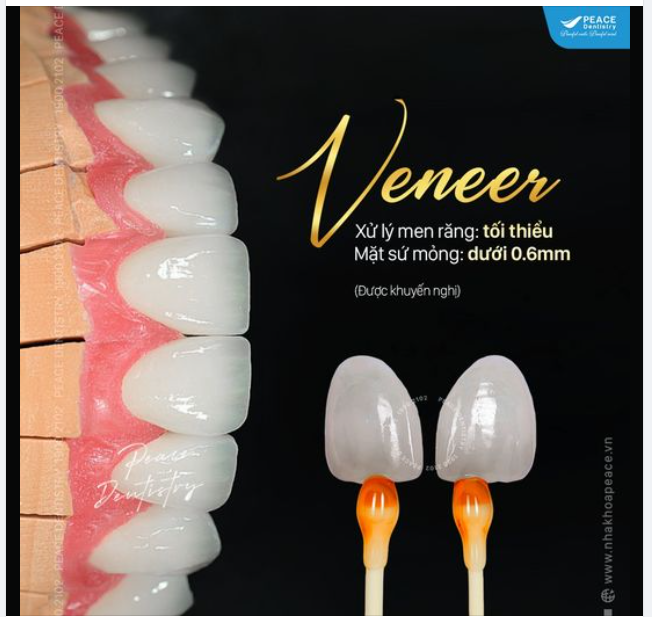 DÁN VENEER CÓ HẠN CHẾ VIỆC ĂN NHAI HAY KHÔNG?