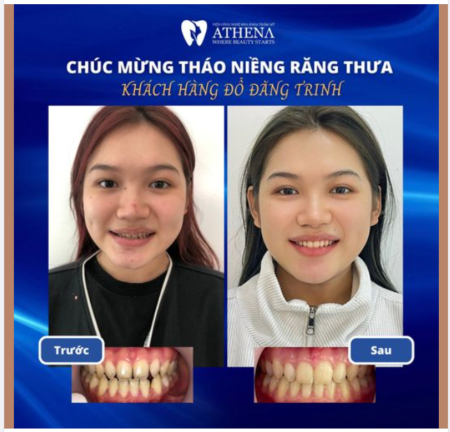 Chữa Răng Thưa với Niềng Răng Mắc Cài Có Được Không?