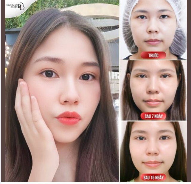 SỞ HỮU MẮT 2 MÍ TO TRÒN SẮC NÉT