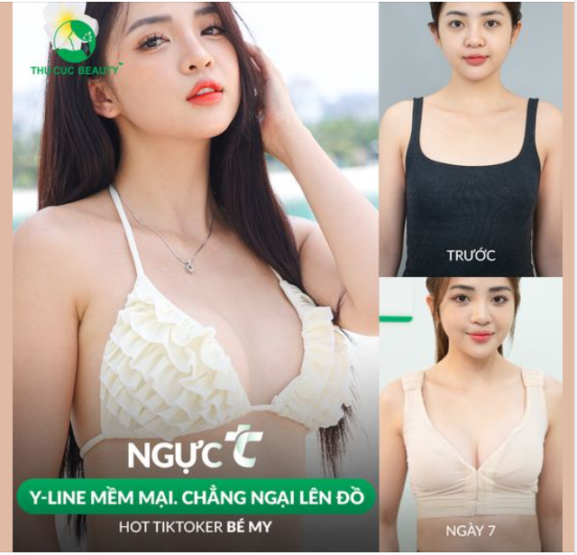"Đập tan" tự ti ngực lép chỉ sau 1 tháng thực hiện Nâng ngực