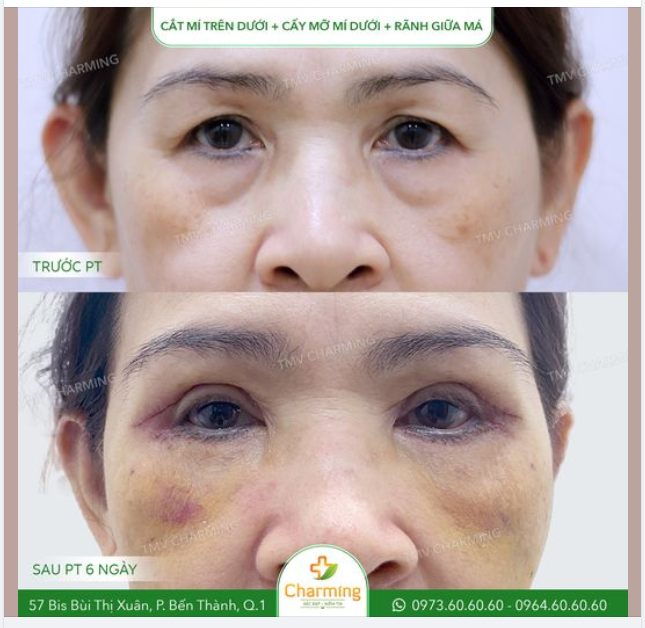 Thời gian dần trôi, đôi mắt chúng ta sẽ là nơi xuất hiện dấu hiệu của lão hóa đầu tiên.