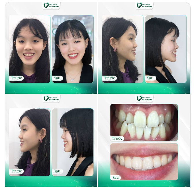 NIỀNG RĂNG MỘT LẦN, CƯỜI ĐẸP MỘT ĐỜI