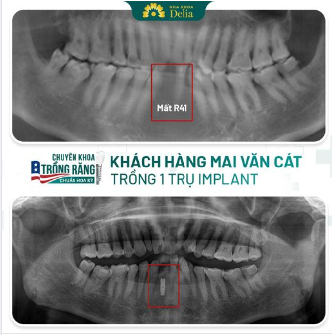 Mất răng cửa - Trồng răng implant khắc phục hiệu quả