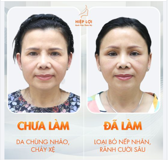 Cải thiện rõ rệt sau khi "căng da" của chị khách