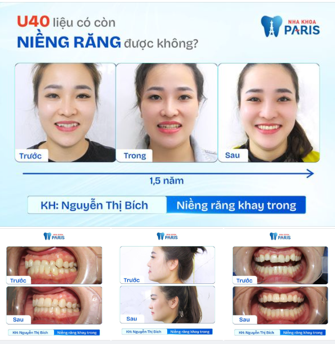 30-40 TUỔI LIỆU CÓ CÒN NIỀNG RĂNG ĐƯỢC NỮA KHÔNG?