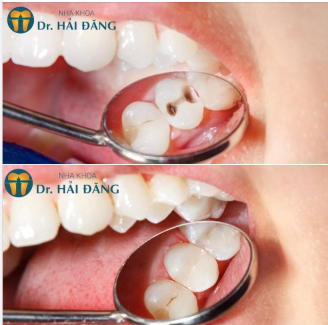 TẠM BIỆT RĂNG SÂU BỐ MẸ CHẲNG PHẢI LO