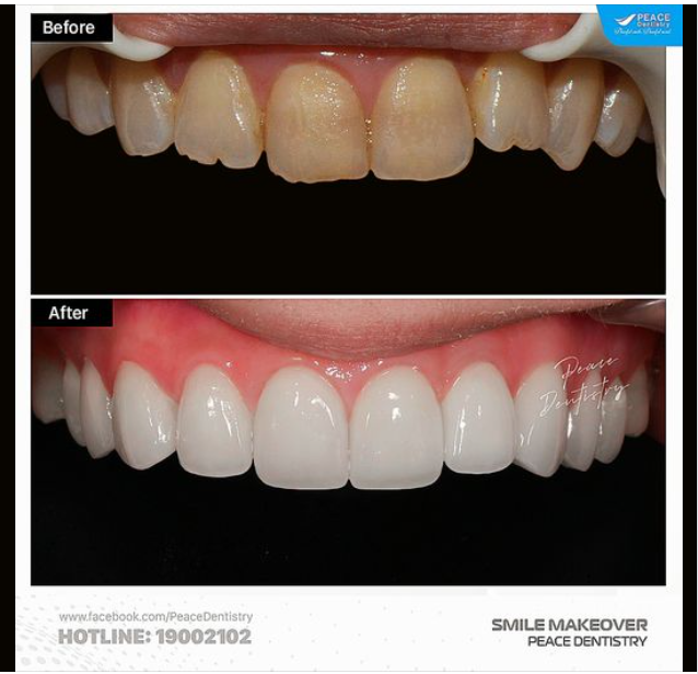 LÀM SAO ĐỂ CA DÁN SỨ VENEER ĐẠT HIỆU QUẢ CAO?