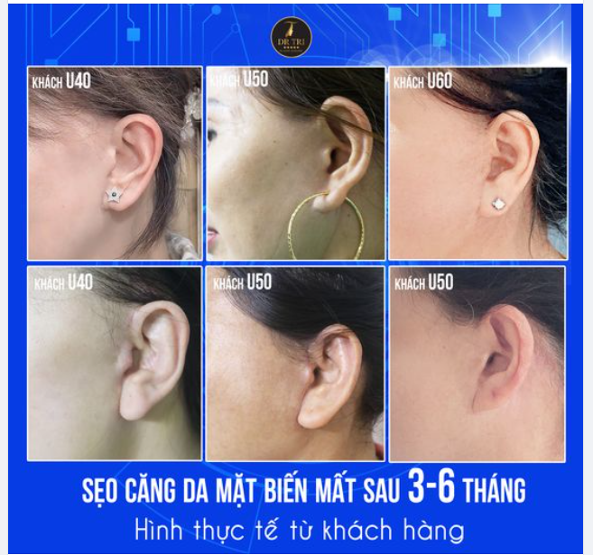Điểm đặc biệt CĂNG DA GIẤU SẸO của Dr Trí là sẹo sẽ dần biến mất từ 3-6 tháng dù khách hàng ở độ tuổi nào!