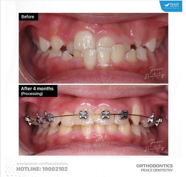 TỐI ƯU THỜI GIAN NIỀNG RĂNG VỚI SỰ HỢP LÝ VÀ CHÍNH XÁC TRONG PHÁC ĐỒ CHỈNH NHA
