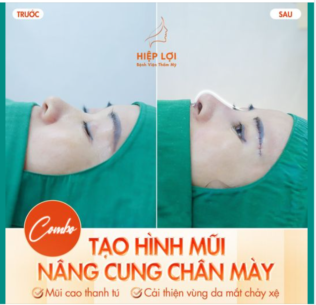 COMBO Tạo hình mũi - Nâng cung chân mày