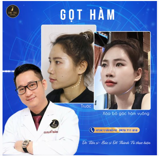 Bây giờ đã tự tin về gương mặt rồi nhé cô gái! Gương mặt mượt mà đường viền rõ nét nhờ Gọt hàm!