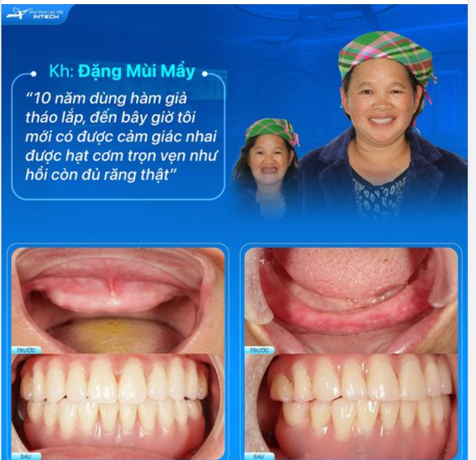 HƠN CHỤC NĂM DÙNG HÀM GIẢ THÁO LẮP ĂN UỐNG KHÓ KHĂN SAU TRỒNG RĂNG IMPLANT ĐÃ THAY ĐỔI HOÀN TOÀN