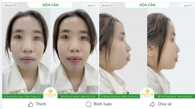 Cằm lẹm, cằm ngắn khiến cho cả gương mặt nàng khách thiếu cân đối, bị hô và không gọn gàng. Vậy nên nàng đã đến Charming thực hiện phẫu thuật độn cằm để khắc phục tình trạng này.