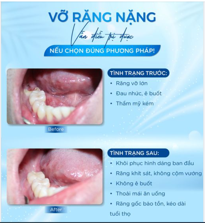 "CỨU" THÀNH CÔNG CHIẾC RĂNG SÂU VỠ GẦN HẾT THÂN RĂNG