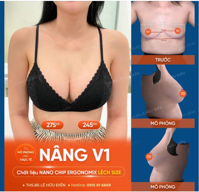 V1 LÊN DÁNG ĐẸP XUẤT SẮC SAU 1 THÁNG THỰC HIỆN