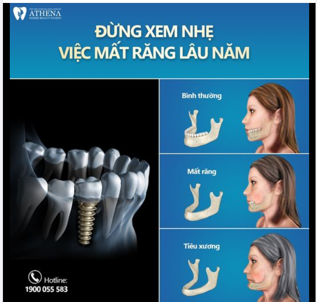 ĐỪNG XEM NHẸ VIỆC MẤT RĂNG LÂU NĂM!!
