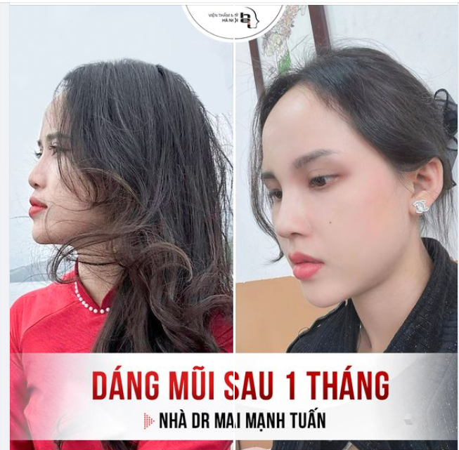 NGHIỆN GÌ CÓ THỂ CAI CHỨ NGHIỆN NÂNG MŨI TẠI VTMHN KHÔNG THỂ LÀO CAI