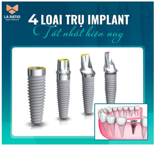 4 LOẠI TRỤ IMPLANT TỐT .N.H.Ấ.T. HIỆN NAY