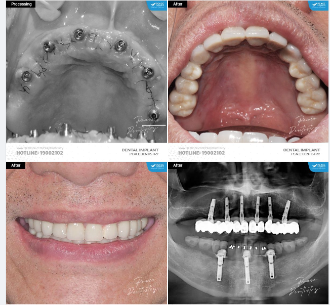 ALL-ON-X IMPLANT VÀ NHỮNG LỢI ÍCH TUYỆT VỜI