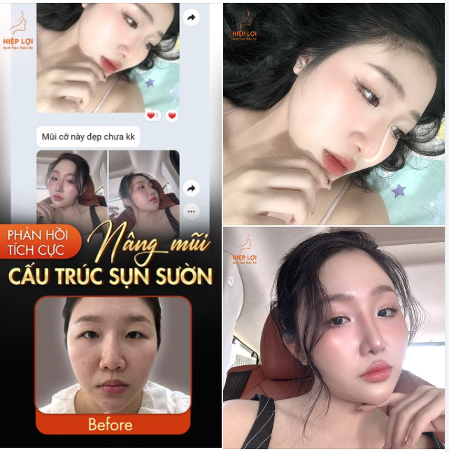 FEEDBACK từ khách hàng NÂNG MŨI CẤU TRÚC SỤN SUỜN sửa lại.