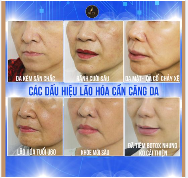 Có những dấu hiệu lão hóa này thì tốt nhất nên chọn căng da nhé quý Anh/Chị!