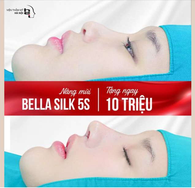 Nâng mũi Bella Silk 5S - Tạo hình dáng mũi Sline chỉ sau 45 phút, khắc phục mọi dáng mũi tẹt, to bè, gẫy, dị dạng...