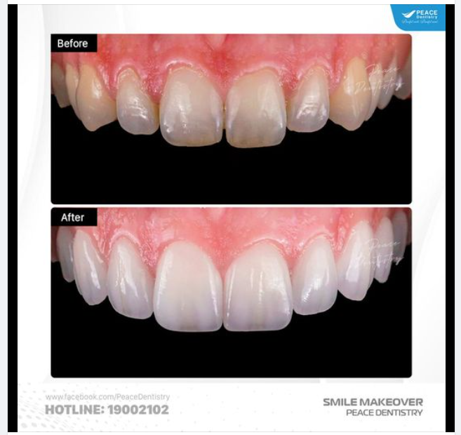 MẶT SỨ VENEER - CHIẾC MẶT NẠ TỰ NHIÊN HOÀN HẢO CHO NỤ CƯỜI RẠNG RỠ