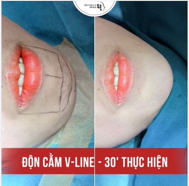 GƯƠNG MẶT THANH THOÁT CẰM CHUẨN VLINE