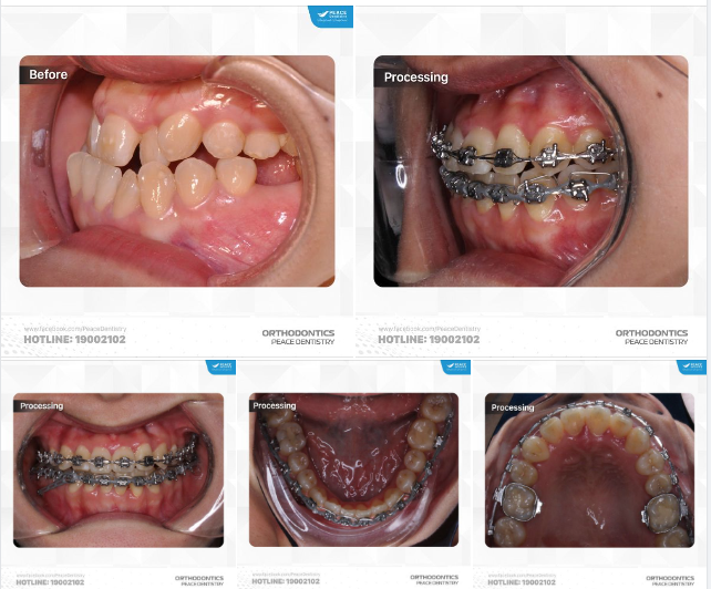 TIẾN TRÌNH MỘT CA CHỈNH NHA CÓ ĐỘ KHÓ CAO VỚI TÌNH TRẠNG ĐẶC BIỆT PHỨC TẠP