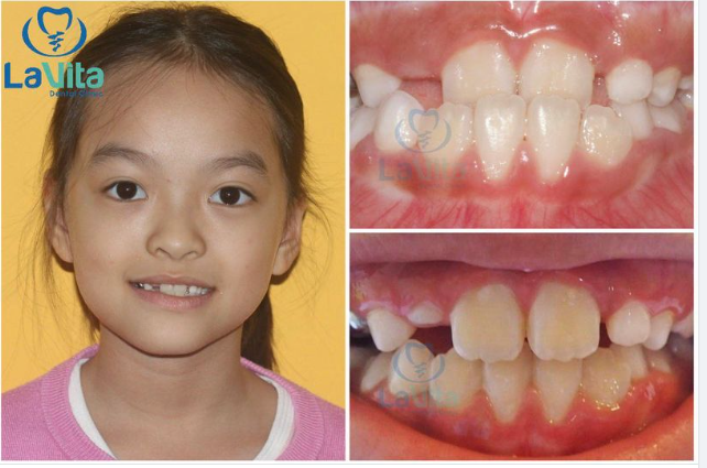 Ngay từ khi trẻ mới 6,7 tuổi, nếu trẻ bị khớp cắn ngược, bố mẹ đã có thể nhìn thấy rất rõ ràng bằng biểu hiện Răng cửa phía trên nằm ở phía trong của răng cửa dưới.
