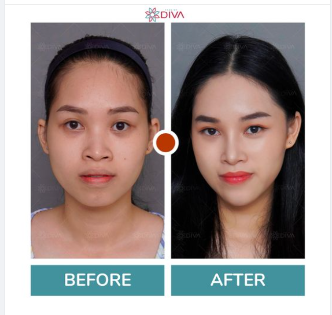 Vẻ đẹp tự nhiên, thon gọn, thanh thoát của cô gái sau thực hiện 4 dịch vụ thẩm mỹ tại DIVA