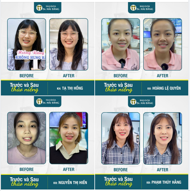 Mỗi khách hàng khi đến với Nha khoa Hải Đăng với các tình trạng như răng hô, móm, khấp khểnh, lệch khớp cắn…