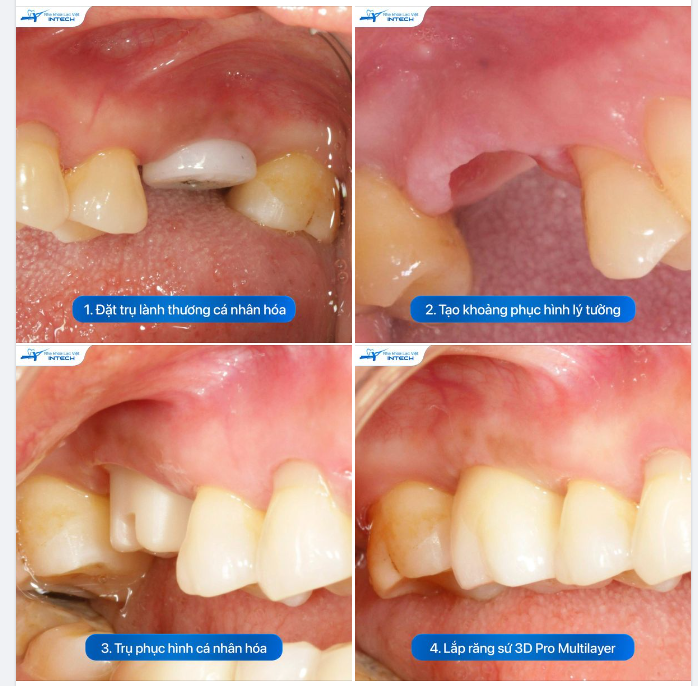 CẬN CẢNH RĂNG IMPLANT DCT: THẨM MỸ NHƯ RĂNG THẬT, ĂN NHAI THOẢI MÁI