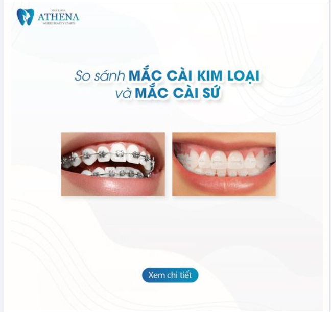 So sánh Niềng Răng Mắc Cài Kim Loại và Niềng Răng Mắc Cài Sứ: Bạn Chọn Phương Pháp Nào?