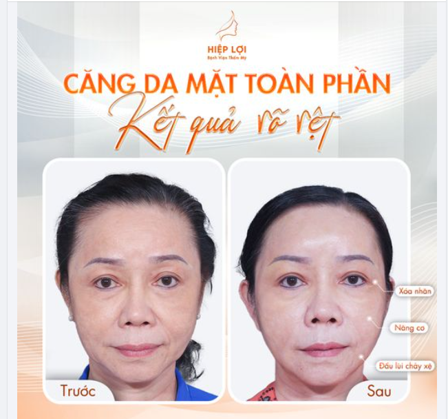 Căng da mặt toàn phần - Kết quả rõ rệt chỉ sau 1 lần thực hiện