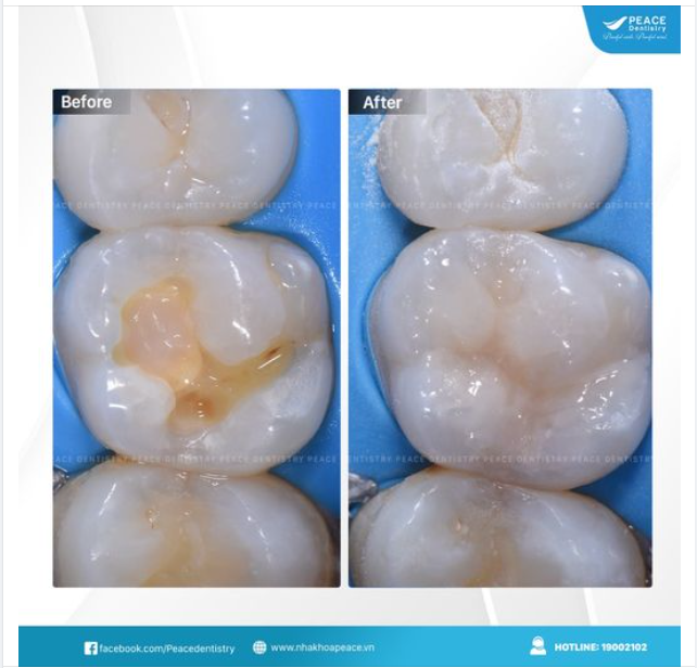 TRÁM RĂNG CŨNG PHẢI ĐƯỢC LÀM ĐÚNG LÀM TỐT!
