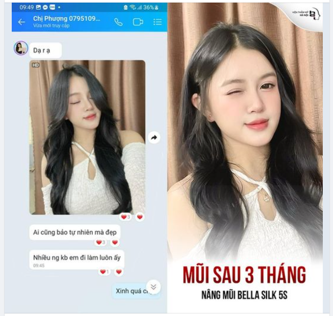 Cô ấy và hơn 500.000 khách hàng trên khắp cả nước đã thực hiện nâng mũi Bella Silk 5S tại VTMHN thành công
