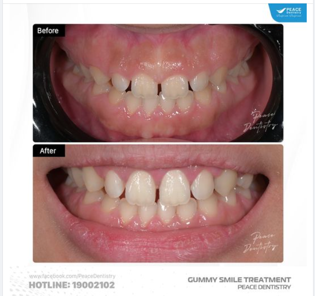 CA PHẪU THUẬT CẮT NƯỚU LÀM DÀI THÂN RĂNG CÓ ĐIỀU CHỈNH Ổ XƯƠNG VÀ HÌNH ẢNH SAU 2 TUẦN
