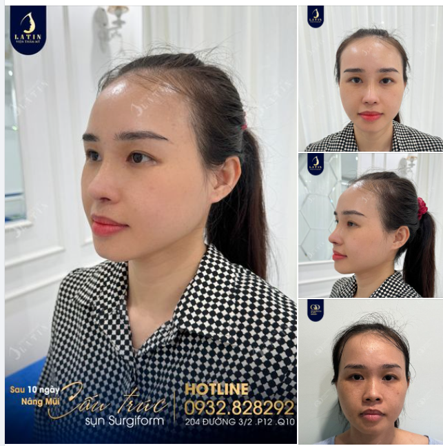 Mũi cấu trúc surgiform 10 ngày tuổi lên dáng thế này xứng đáng điểm 10 phải không cả nhà