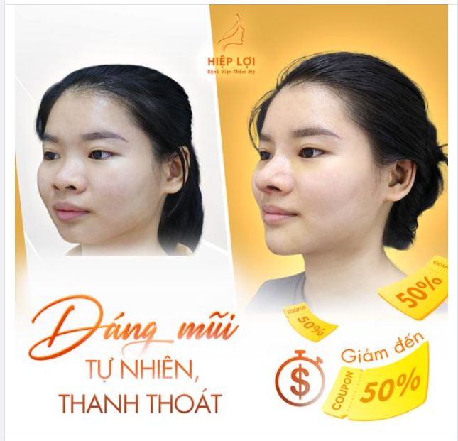 Dáng mũi "tự nhiên" cực "thanh thoát" - Sau 10 ngày của khách yêu