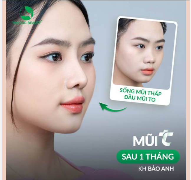 Khoe nhẹ dáng mũi cân mọi góc nhìn của Bảo Anh sau 1 tháng nâng mũi tại Thu Cúc